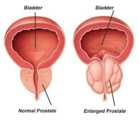 Comprehensive Benign Prostatic Hypertrophy (BPH) C...