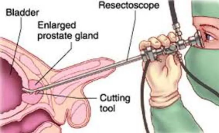Advanced TURP Procedure for Prostate Care in Thane...
