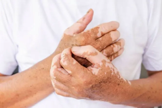 Vitiligo Treatment: Restore Skin Pigmentation at G...