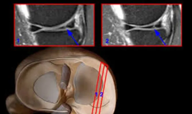 Expert Care for Medial Meniscus Tear by Dr. Rakesh...