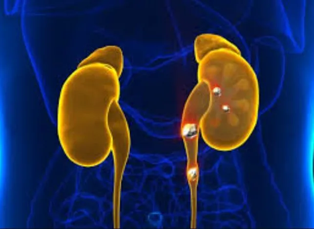 Best Treatments for Kidney Stones at Our Clinic Ki...