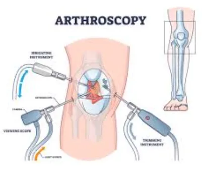 Arthroscopy Services Offered by Anand Orthopaedic ...