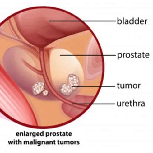 Comprehensive Prostate Treatment Solutions in Than...