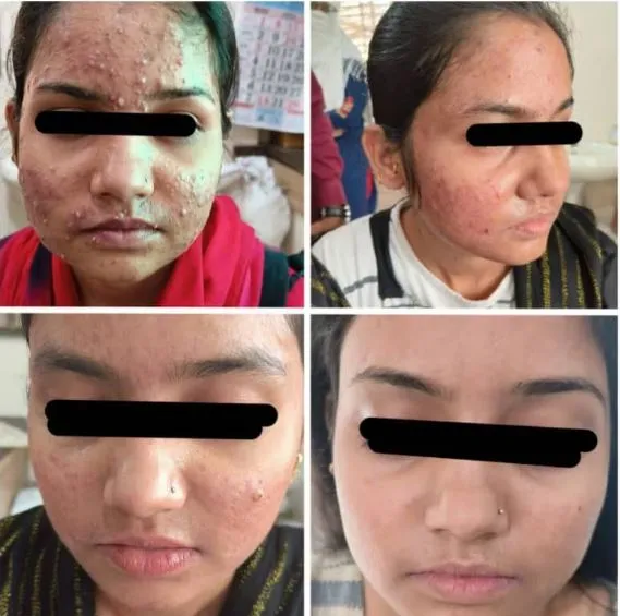 Rejuvenate Your Skin with Chemical Peeling at Gind...