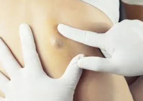 Best Lipoma Removal Doctor in Kalyan When it comes...