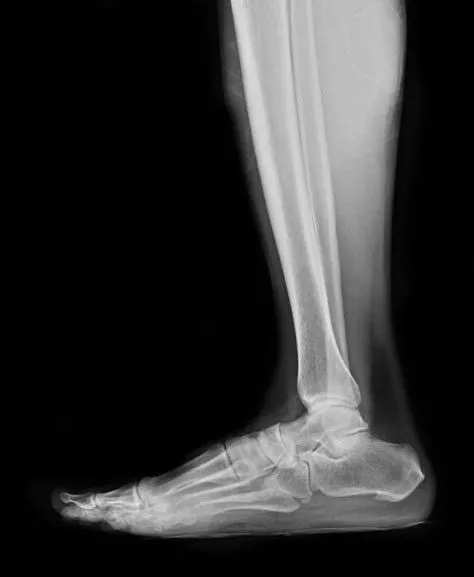 Advanced Treatment for Long Bone Fractures by Dr. ...
