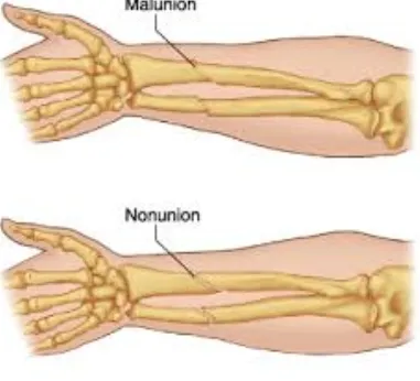 Nonunion Malunion Treatment Options at Anand Ortho...
