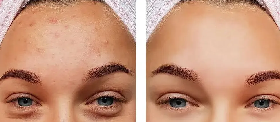 Acne Treatment in Pune Effective Acne Treatment at...