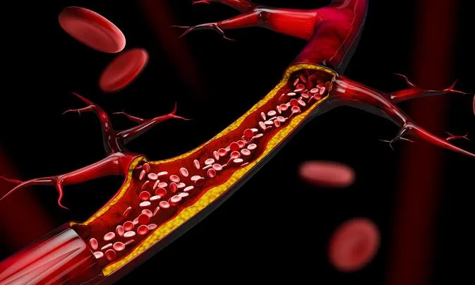 Expert Care for Coronary Artery Disease at SR Hear...