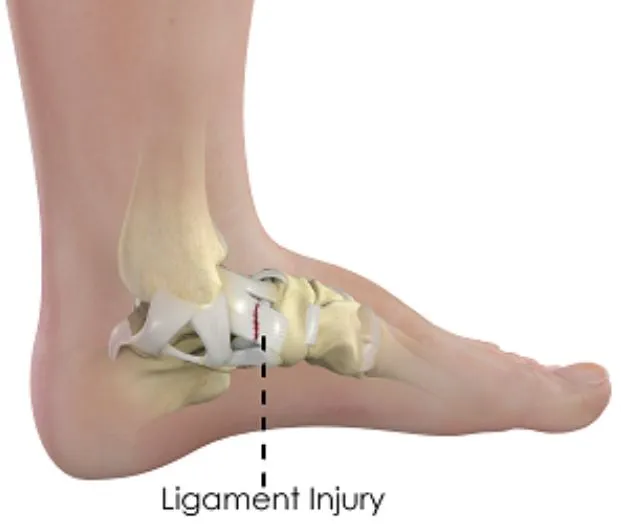 Ligament Injury Treatment in Nashik Expert Care fo...