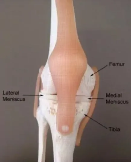 Comprehensive Care for Lateral Meniscus Tears by D...