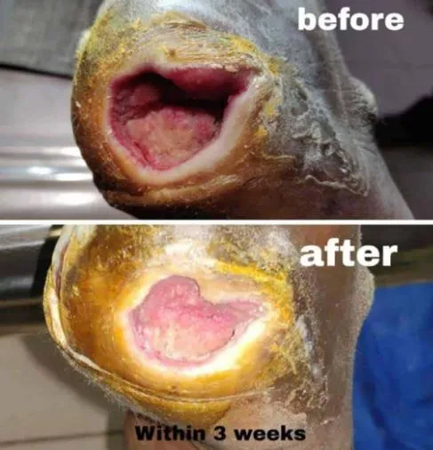 Effective PRP Therapy for Non-Healing Wounds Gindo...