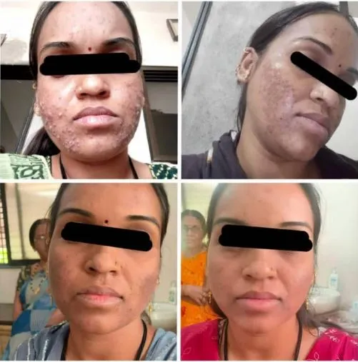 Transform Your Skin with PRP Therapy for Acne and ...