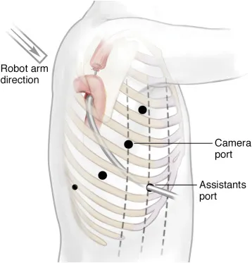 Why ROBOT ASSISTED ESOPHAGEAL SURGERY Robot-assist...