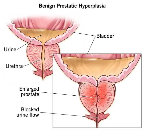 Effective Treatment for Benign Prostatic Hypertrop...