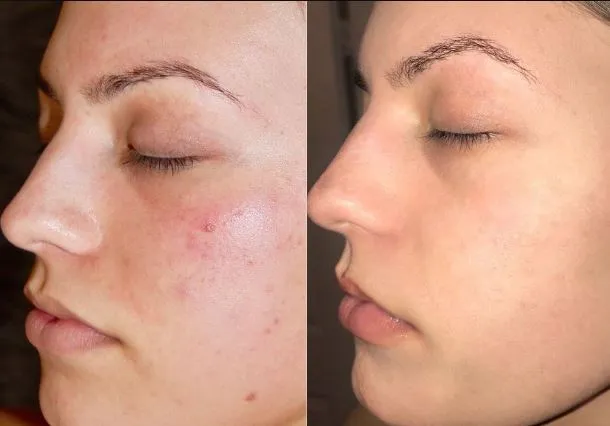 Chemical Peeling Services at Gindodia Hospital Unl...