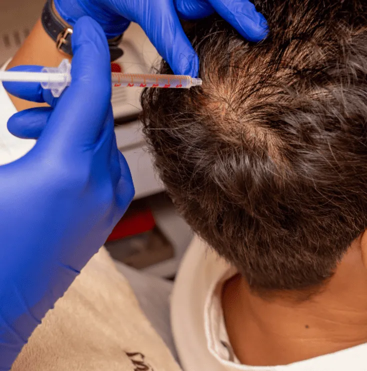 PRP Therapy for Hair: Restore Your Hair Naturally ...