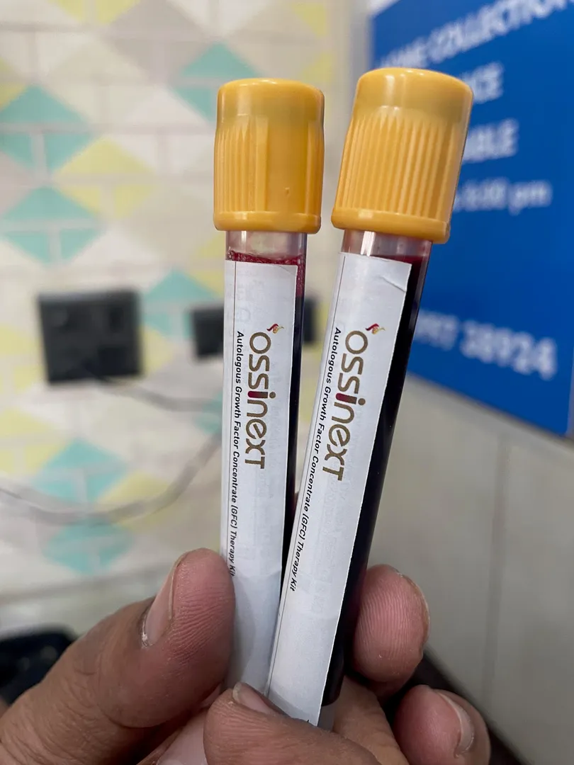 GFC (Growth factor concentrate) for treatemnt of T...