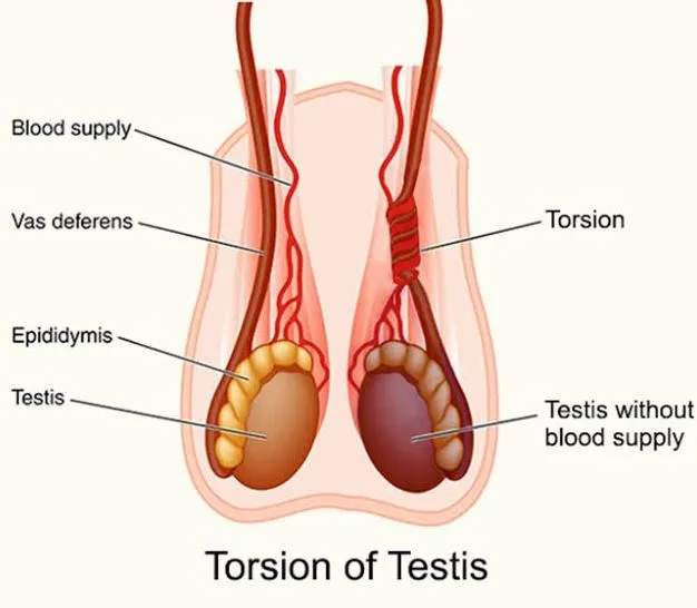 Expert Care for Testicular Pain in Thane Understan...