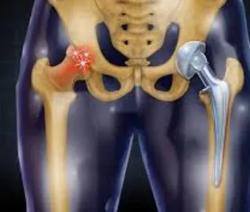 Hip Replacement treatment in Pune Superior Hip Rep...