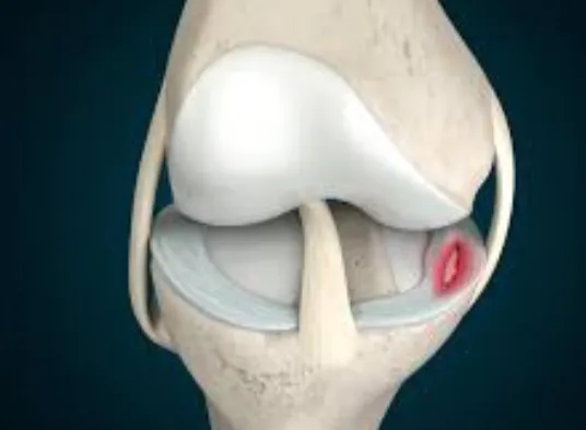 Medial Meniscus Tear Care in Nashik Specialized Me...