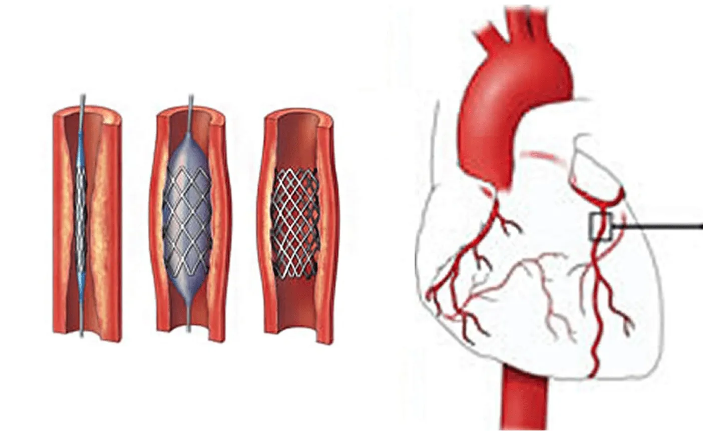 Completion of Angiography Services at Dr. K G Desh...