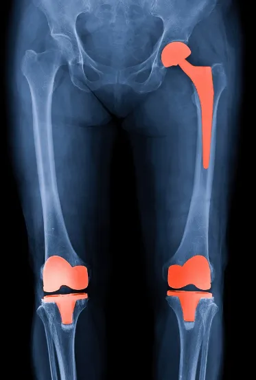 Knee and Hip Replacement treatment in Pimpri-Chinc...
