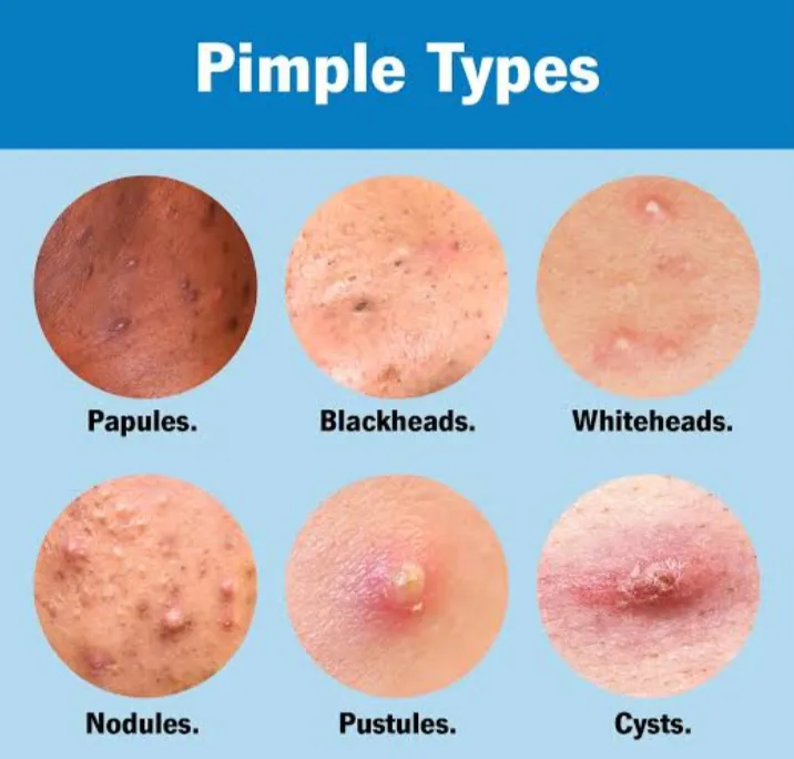 Skin Rejuvenation, Acne scar, Fine lines and Wrink...