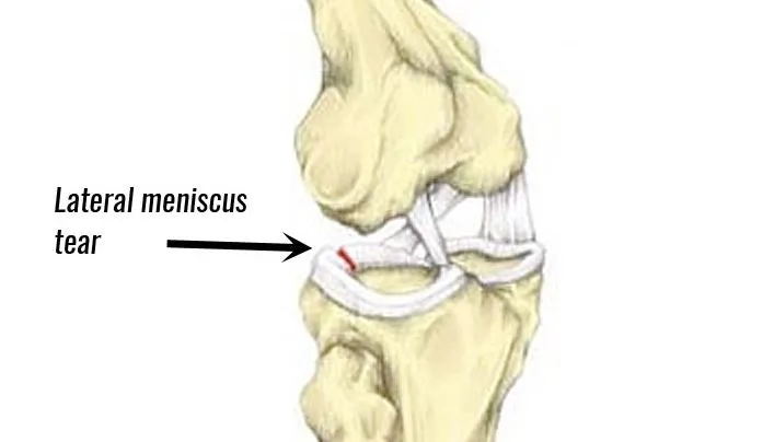 Advanced Lateral Meniscus Tear Treatment in Nashik...