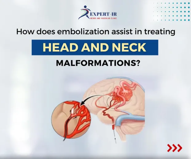 Embolization allows for precise targeting of the m...