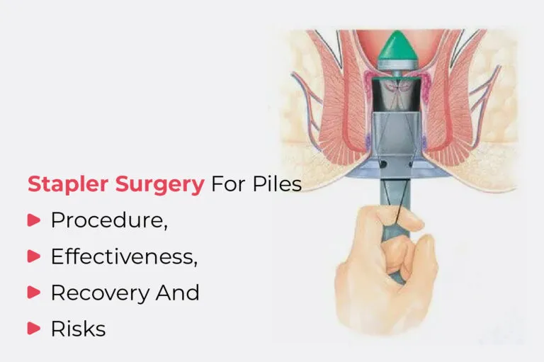 STAPLER PILES SURGERY .
SHREE HOSPITAL , VASHI ...