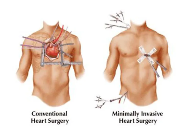 Small Incision Cardiac Surgery in Nagpur Benefits ...