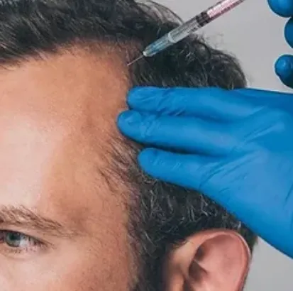 Hair Regrowth Treatment at TRu Aesthetics Top Hair...