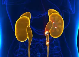 Kidney Stone Removal in East
Kidney Stone Removal ...