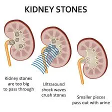 Kidney Stone Removal in Mulund
Kidney Stone Remova...