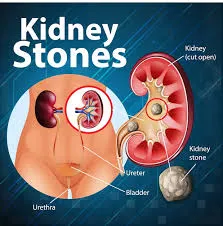 Kidney Stone Removal in Bhiwandi
Kidney Stone Remo...