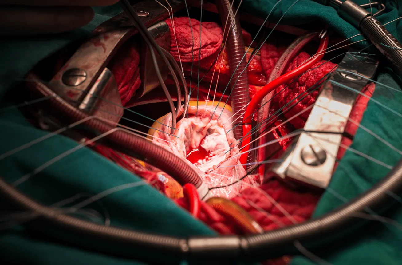 Valve Surgery Expertise at Our Nagpur Centre Compr...