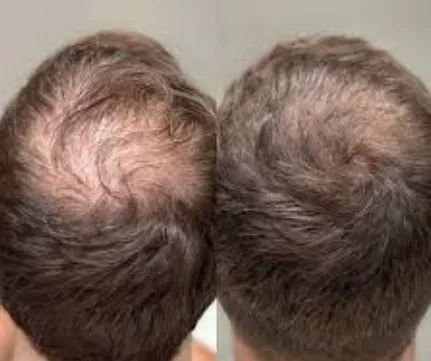 PRP Therapy For Hair at TRu Aesthetics Leading PRP...
