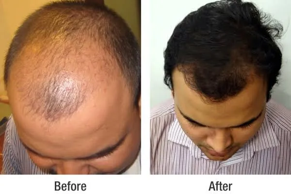 Transform Your Look: Hair Transplantation at Dr. R...