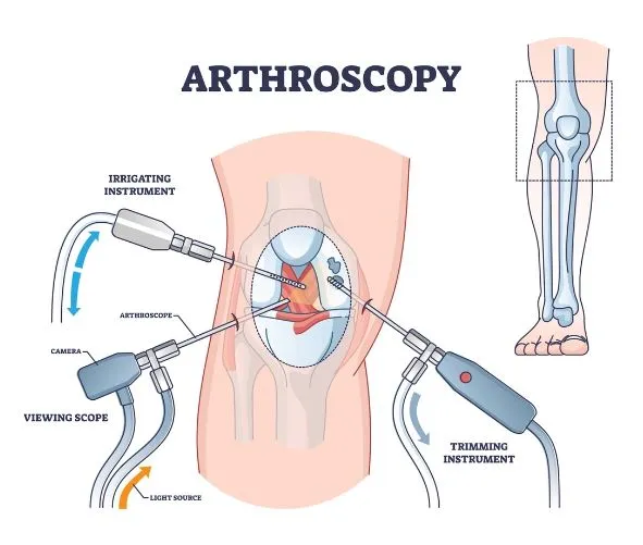 Expert Arthroscopy Treatment in Nashik by Dr. Rake...