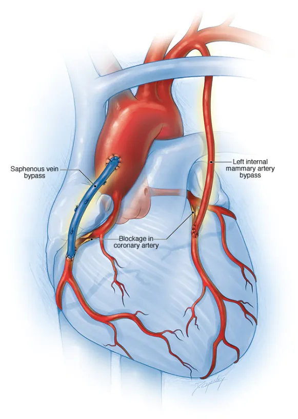 Beating Heart Bypass Surgery at Dr. K G Deshpande ...