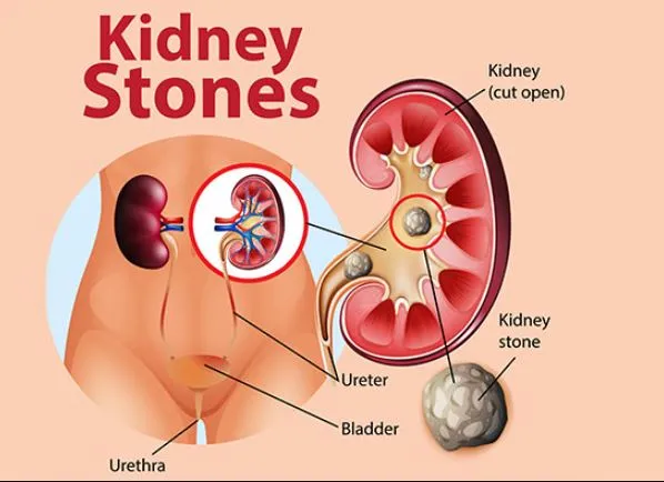 Best Kidney Stone Treatment in Thane - Advanced Ca...