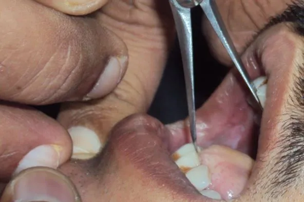 Submucous Fibrosis Treatment at Gindodia Hospital ...