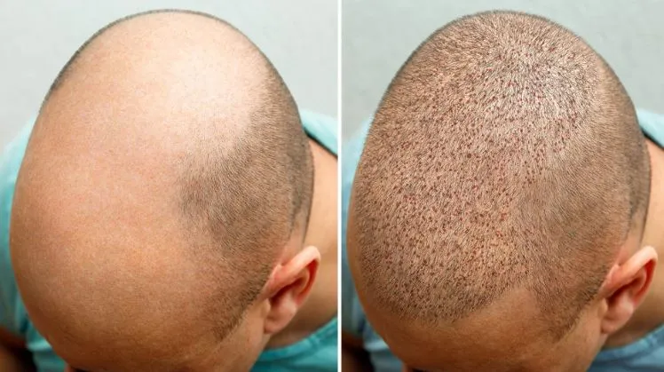 Premier Hair Transplant Clinic in Nashik Restore Y...