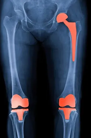 Knee and Hip Replacement at Anand Orthopaedic Hosp...