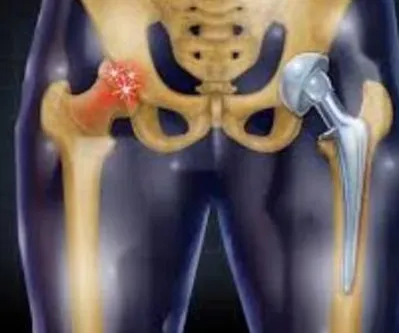 Hip Replacement Surgery at Dr. Saraf’s Joints Clin...