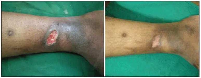 Advanced PRP Therapy for Non-Healing Wounds at Gin...