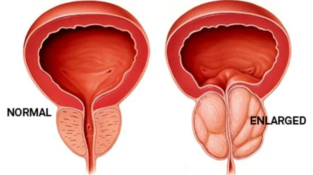 Prostate Treatment in Thane - Comprehensive Care b...