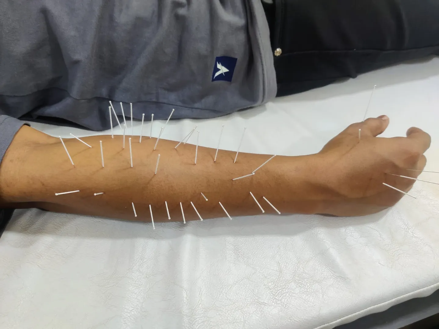 **Novel Treatment of Writer's Cramp Using Ultrasou...