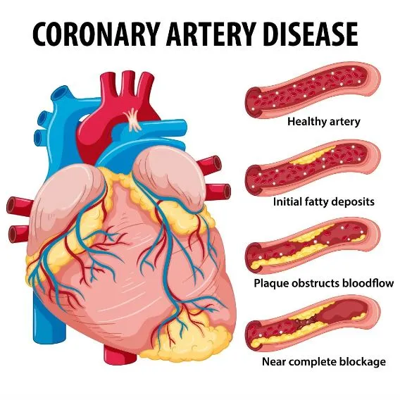 Specialized Coronary Artery Disease Care at SR Hea...